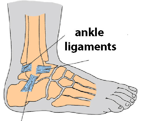 Treating a Sprained Ankle – esolepacks.com